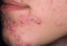 Прыщи на подбородке у женщин — фото, все причины и лечение