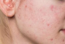 Акне на щеках: лечение и причины, диагностика (фото)