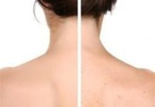 Как избавиться от прыщей на спине: 13 причин, 23 лучших способа лечения