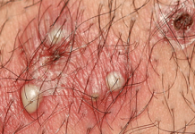 Что делать, если появился прыщик на лобке, Венерические заболевания у женщин