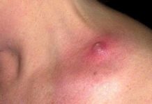 Прыщи на плечах: причины сыпи и возможные проблемы