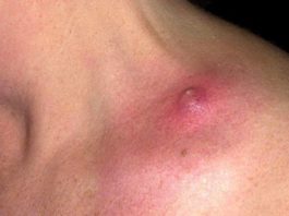 Прыщи на плечах: причины сыпи и возможные проблемы