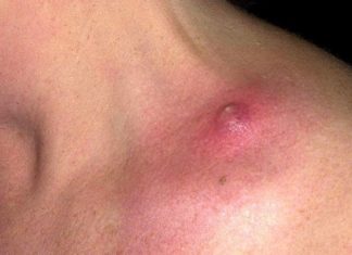 Стоит ли использовать ложечку Уно для выдавливания угревой сыпи на лице? | Лечение акне и розацеа препаратом Азелик®