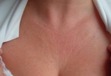 Сыпь на грудине у женщин: причины и лечение сыпи в виде прыщиков и потницы