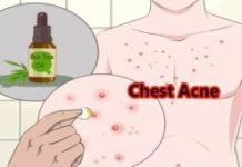 Прыщи на грудине у женщин и мужчин: причины и лечение