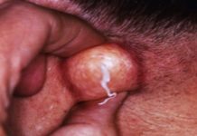 Прыщи в паху у женщин причины, фото