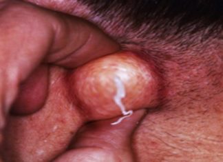 Прыщи в паху у женщин причины, фото