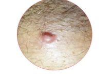 Прыщи на анусе — как выглядят, причины и симптомы, удаления