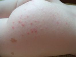 Основные причины появления прыщей на попе у женщин: лечение красных гнойных высыпаний