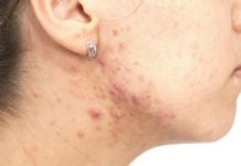 Прыщи на шее у женщин – почему появляются, лечение, виды, фото