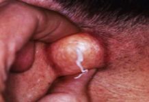 Прыщи в паху у женщин что это такое