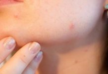 Прыщи после 30 лет: причины, лечение, профилактика