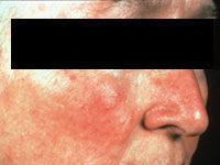 Прыщи на лице в 50 лет: почему могут появиться?
