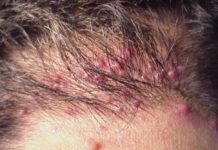 На коже головы появились прыщи и зуд — почему чешутся маленькие прыщики под волосами сзади?