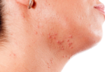 Прыщи за ухом и на шее у женщин: причины высыпания и способы лечения