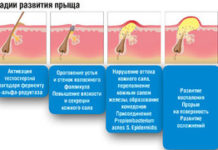Гнойные прыщи на ногах у мужчин и женщин: почему появляются, как избавиться