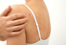 Прыщи на плечах и спине: причины и лечение, использование мазей и народных средств в домашних условиях