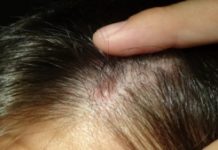 Прыщи на голове в волосах у женщин: почему появляются и чем лечить, советы дерматолога по профилактике акне на волосистой части головы