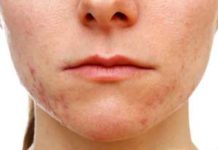 Прыщи на лице в 30 лет у женщины: причины и лечение