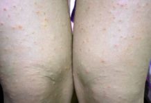 Прыщи на ляшках причины у женщин — Всё о прыщах