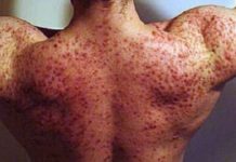 Прыщи из-за тестостерона: причины возникновения, как бороться