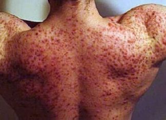 Прыщи из-за тестостерона: причины возникновения, как бороться