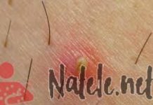 Прыщ на половой губе: ТОП методов лечения, причины, фото, АРМЕДИКА ЭЛИТ