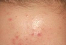 Прыщи при гормональном сбое как лечить — Всё о прыщах