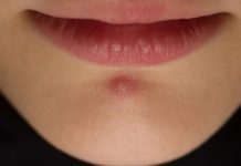 Прыщи на подбородке у женщин: что значит — причины и способы лечения