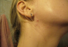 Прыщи за ушами и на шее: как лечить, причины и профилактика