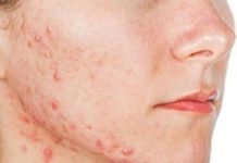 Прыщи на скулах – у женщин, причины, почему появляются, лечение