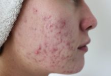 Прыщи на щеках — у женщин, у девушек, причина, как избавиться