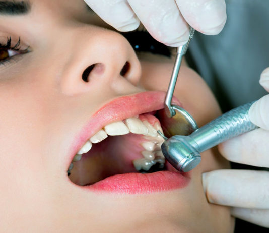 Лечение кариеса зубов Лечение кариеса зубов