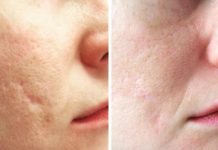 Способы заживления и лечения рубцов