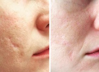 Способы заживления и лечения рубцов