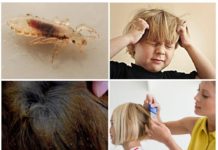 Ребенок заразился вшами: что делать