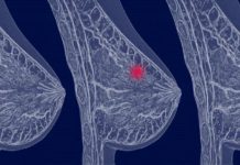 Вид диагностик рака молочной железы Вид диагностик рака молочной железы