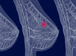 Вид диагностик рака молочной железы Вид диагностик рака молочной железы