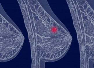 Вид диагностик рака молочной железы Вид диагностик рака молочной железы