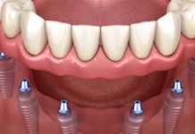 Процедура All-on-6 Процедура All-on-6