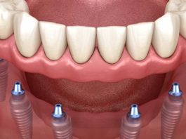 Процедура All-on-6 Процедура All-on-6