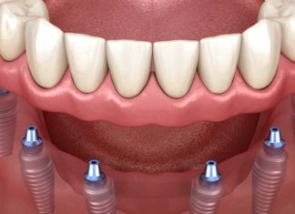 Процедура All-on-6 Процедура All-on-6