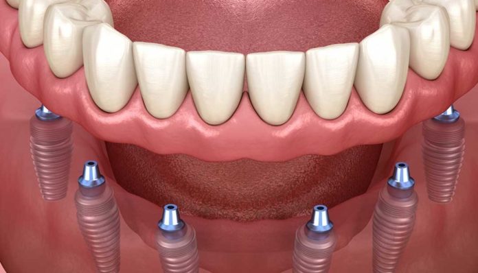 Процедура All-on-6