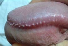 Пупырышки на члене: на головке, белые, на коже, фото, красные, почему, под головкой, маленькие, на стволе, как избавиться