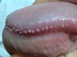 Пупырышки на члене: на головке, белые, на коже, фото, красные, почему, под головкой, маленькие, на стволе, как избавиться