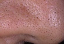 Как удалить черные точки на лице в домашних условиях за 1 день