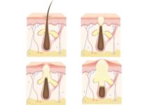 Чем лечить чирей и фурункул на спине: что такое чирей и как выглядит