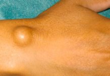 Нужно ли удалять жировики на теле — взвешиваем за и против