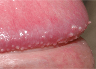 Пупырышки вокруг головки