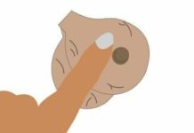 Жировик на мошонке: воспалившийся на яичках у мужчин, народное лечение и методы удаления, причины появление